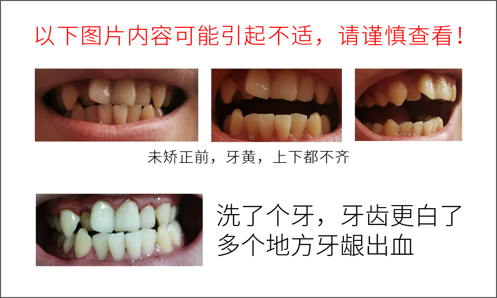 图片[2]-牙齿矫正心得第一期（拍片洗牙）-趣玩吧-LANIN·BK 兰宁博客